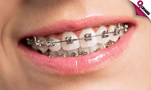 Metal Braces, Adjustment, Retainer & Consultation!